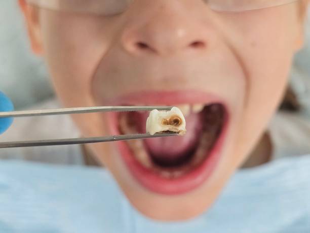 Best Emergency Root Canal Treatment in Eufaula, OK